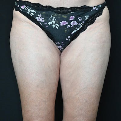 Thigh Lift Before & After Gallery - Patient 274618 - Image 1