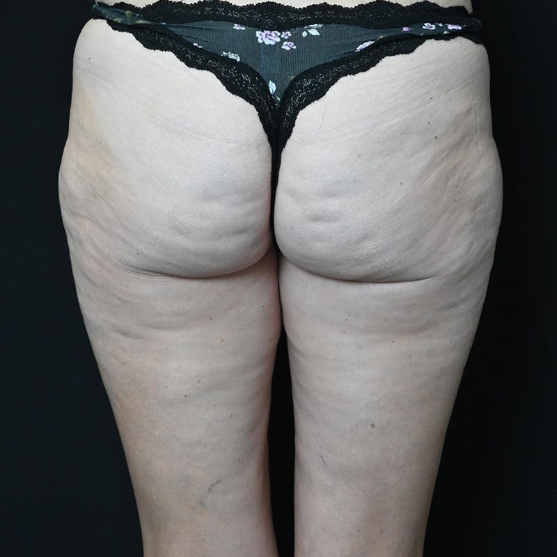 Thigh Lift Before & After Gallery - Patient 274618 - Image 3