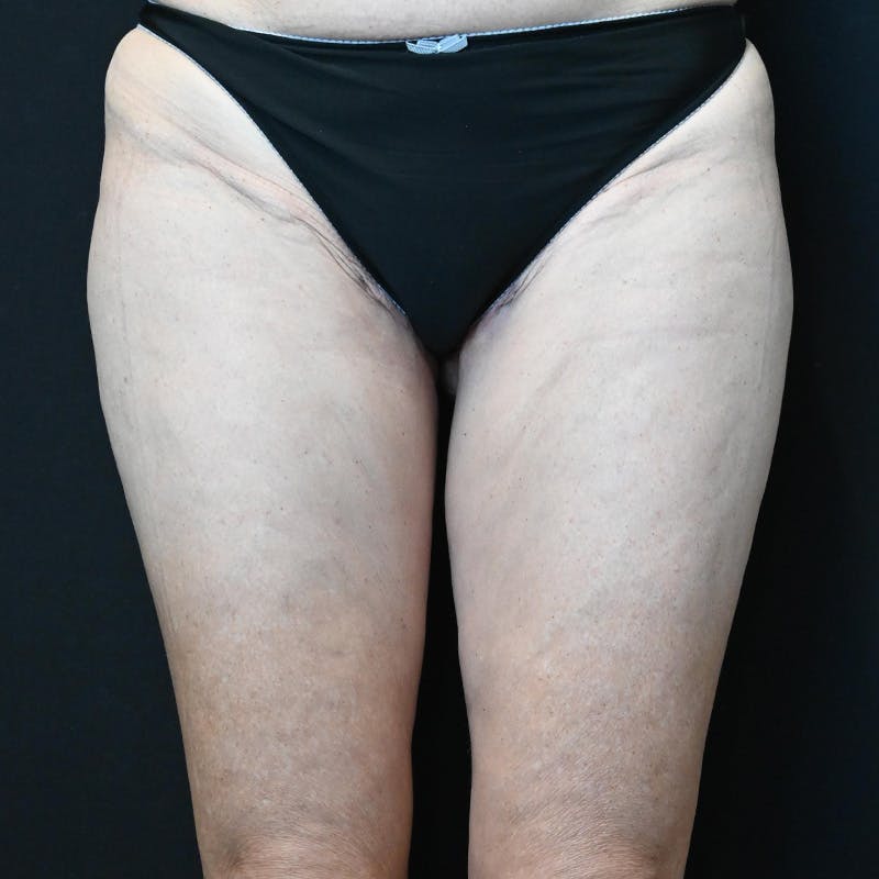 Thigh Lift Before & After Gallery - Patient 274618 - Image 2