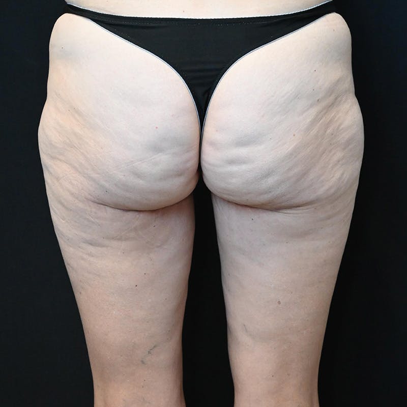 Thigh Lift Before & After Gallery - Patient 274618 - Image 4