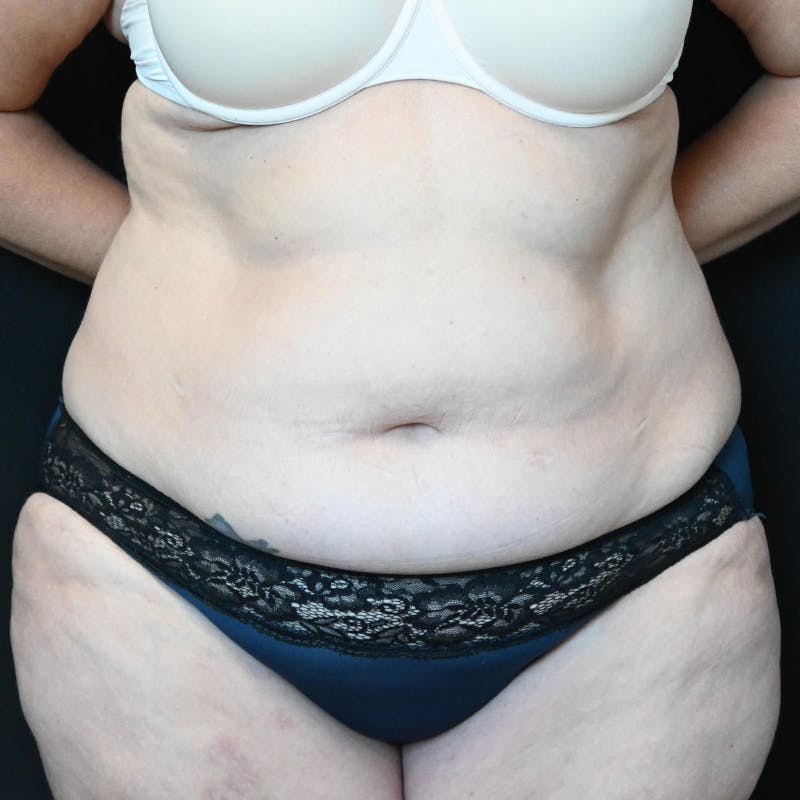 Abdominoplasty (Tummy Tuck) Before & After Gallery - Patient 250981 - Image 1