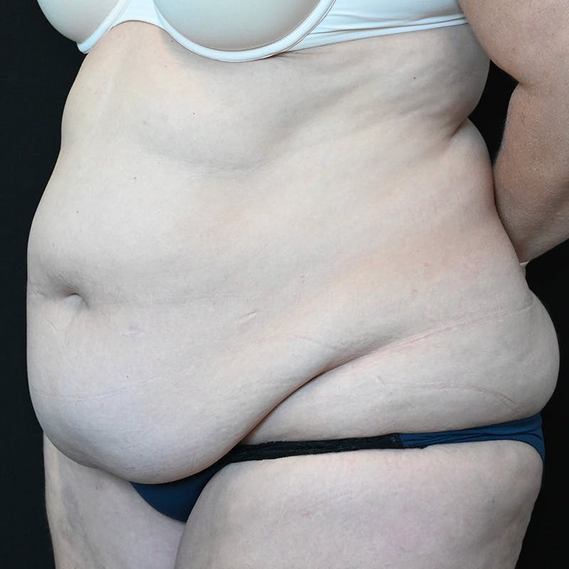 Abdominoplasty (Tummy Tuck) Before & After Gallery - Patient 250981 - Image 7