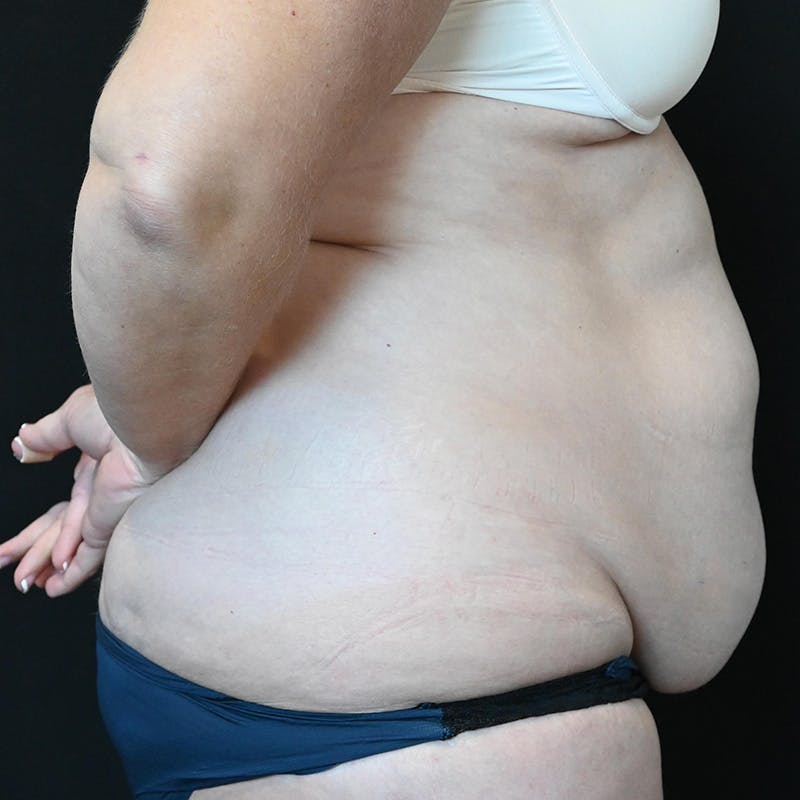 Abdominoplasty (Tummy Tuck) Before & After Gallery - Patient 250981 - Image 5