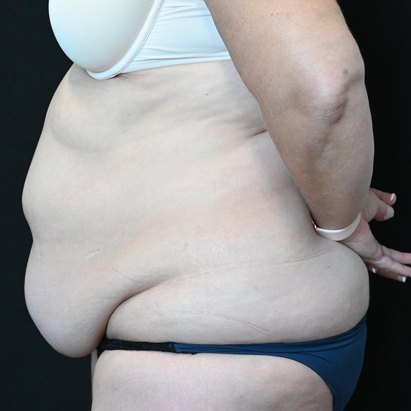 Abdominoplasty (Tummy Tuck) Before & After Gallery - Patient 250981 - Image 9
