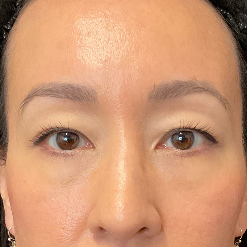 Upper Eyelid Surgery Before & After Gallery - Patient 264213 - Image 1