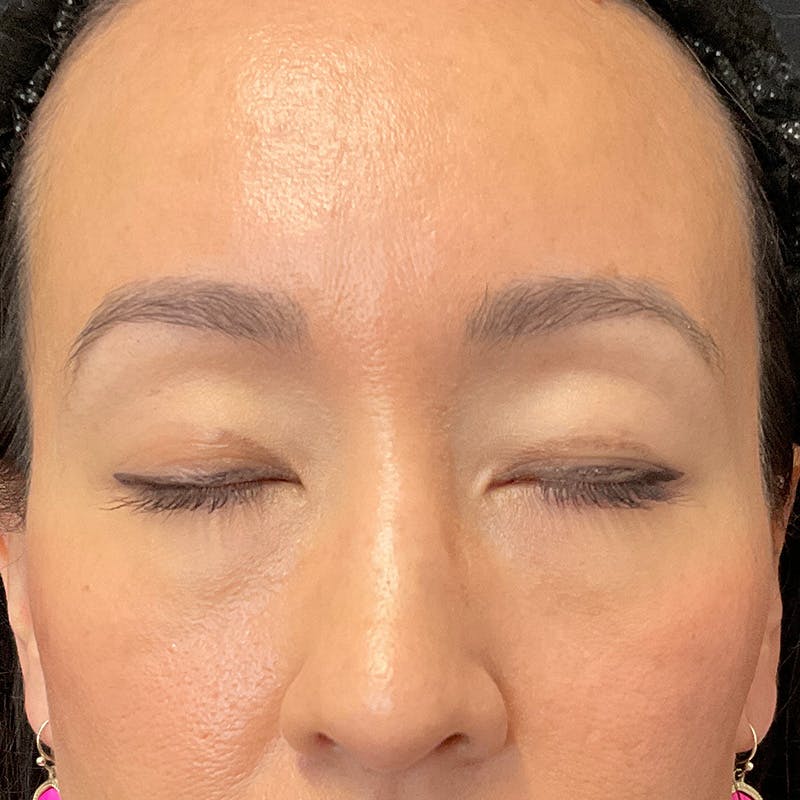 Upper Eyelid Surgery Before & After Gallery - Patient 264213 - Image 3