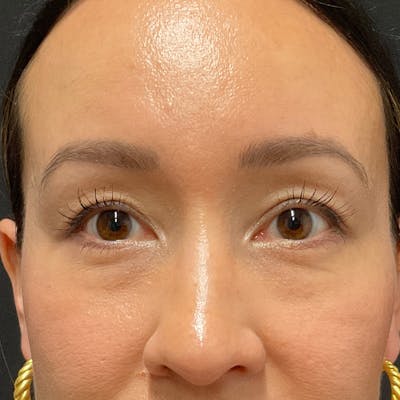 Upper Eyelid Surgery Before & After Gallery - Patient 264213 - Image 2