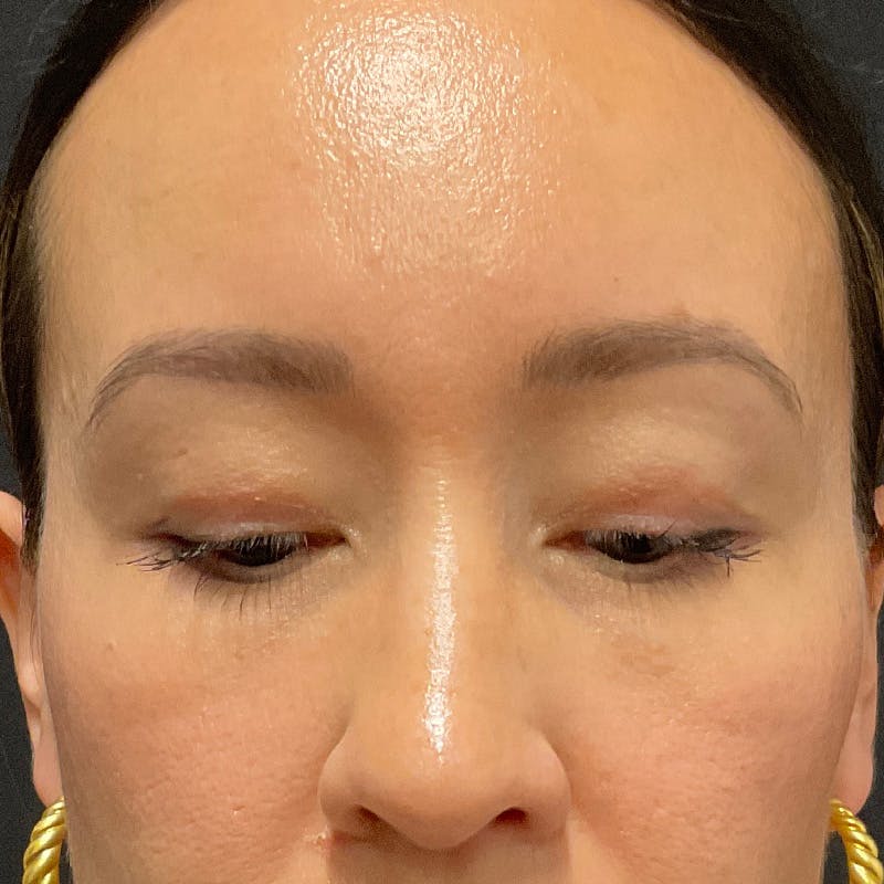 Upper Eyelid Surgery Before & After Gallery - Patient 264213 - Image 4