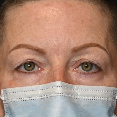 Upper Eyelid Surgery Before & After Gallery - Patient 343463 - Image 1