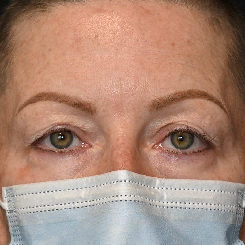 Upper Eyelid Surgery Before & After Gallery - Patient 343463 - Image 1