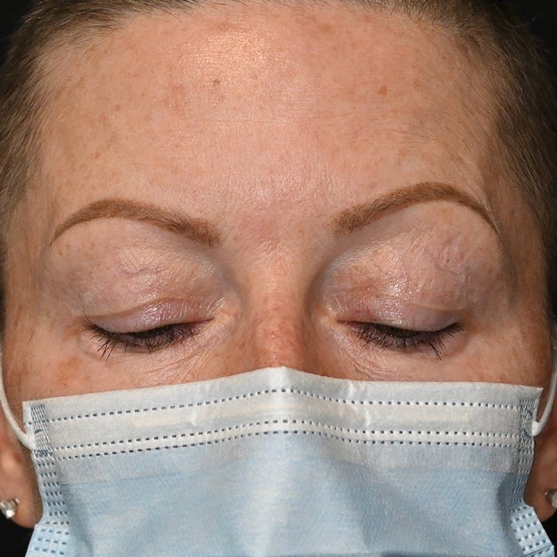 Upper Eyelid Surgery Before & After Gallery - Patient 343463 - Image 3