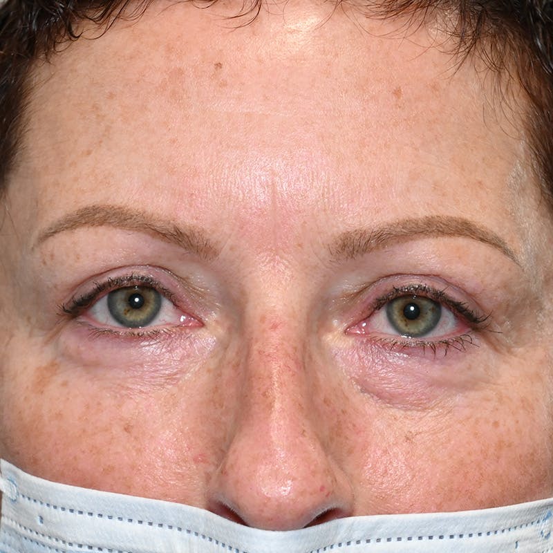 Upper Eyelid Surgery Before & After Gallery - Patient 343463 - Image 2