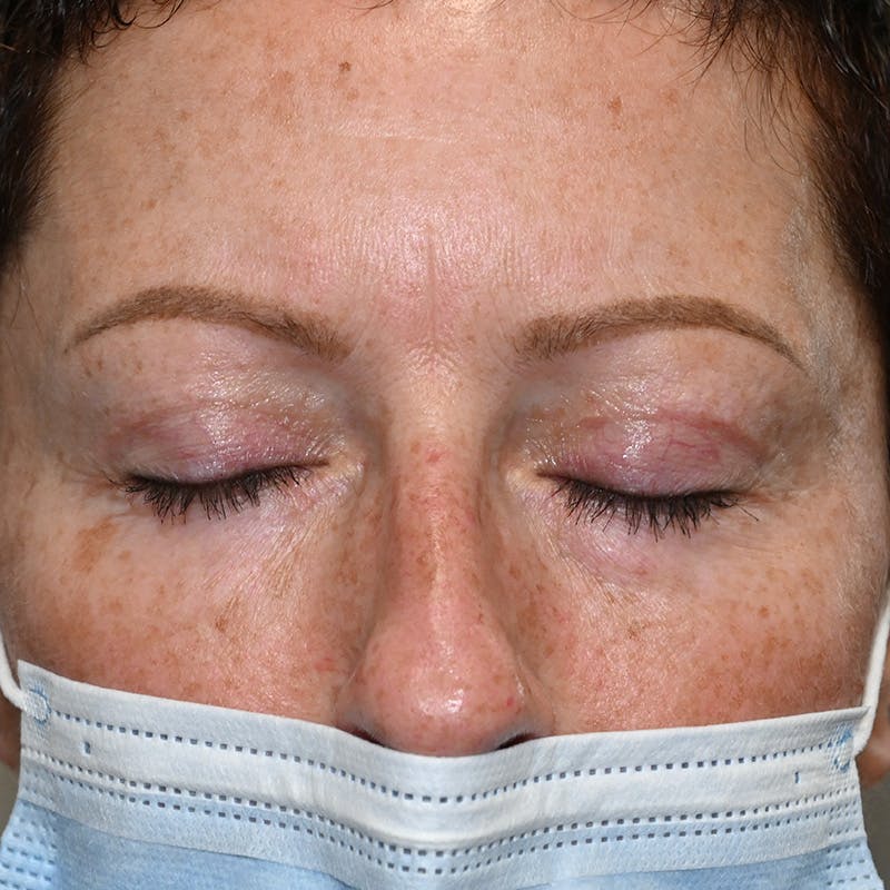 Upper Eyelid Surgery Before & After Gallery - Patient 343463 - Image 4