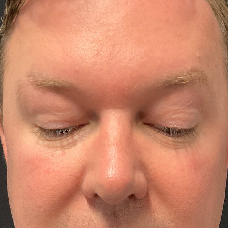 Upper Eyelid Surgery Before & After Gallery - Patient 157641 - Image 3