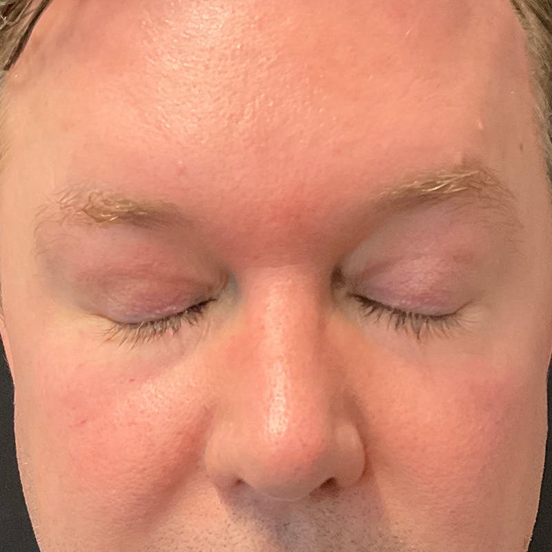 Upper Eyelid Surgery Before & After Gallery - Patient 157641 - Image 4