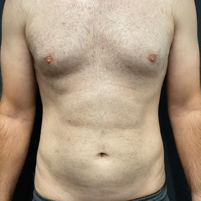 Male Liposuction Before & After Gallery - Patient 275331 - Image 1
