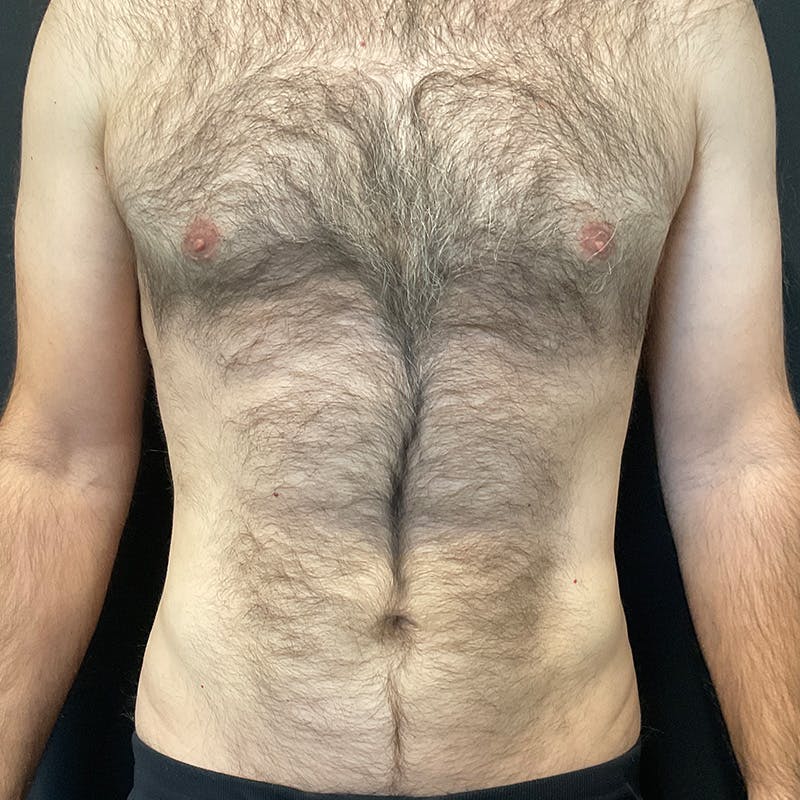 Male Liposuction Before & After Gallery - Patient 275331 - Image 2