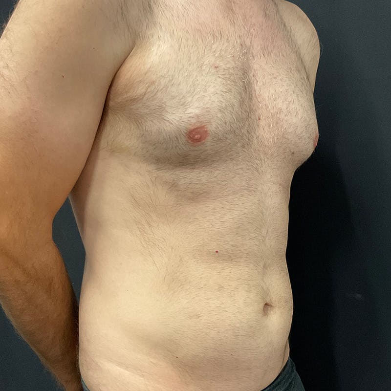 Male Liposuction Before & After Gallery - Patient 275331 - Image 3