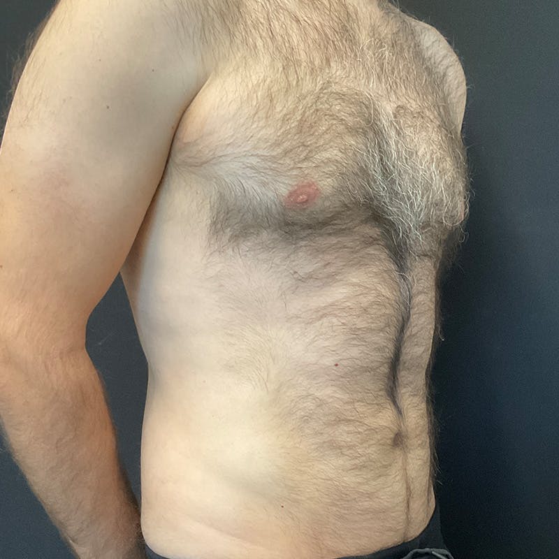 Male Liposuction Before & After Gallery - Patient 275331 - Image 4