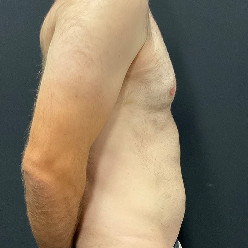 Male Liposuction Before & After Gallery - Patient 275331 - Image 5