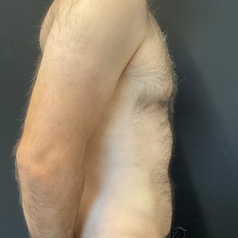 Male Liposuction Before & After Gallery - Patient 275331 - Image 6