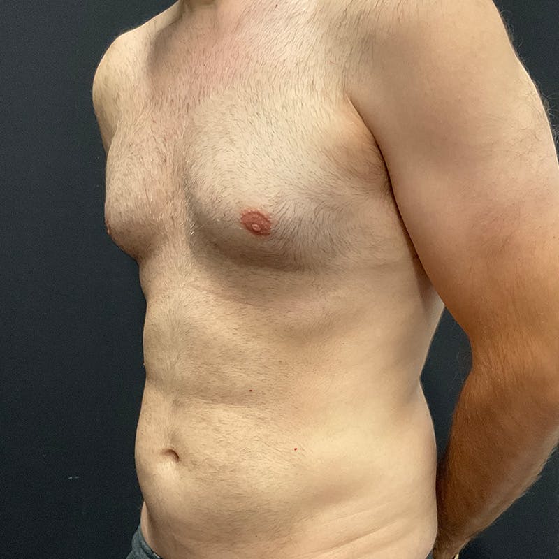 Male Liposuction Before & After Gallery - Patient 275331 - Image 7