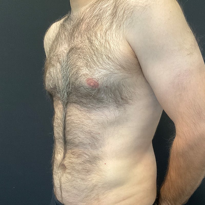 Male Liposuction Before & After Gallery - Patient 275331 - Image 8
