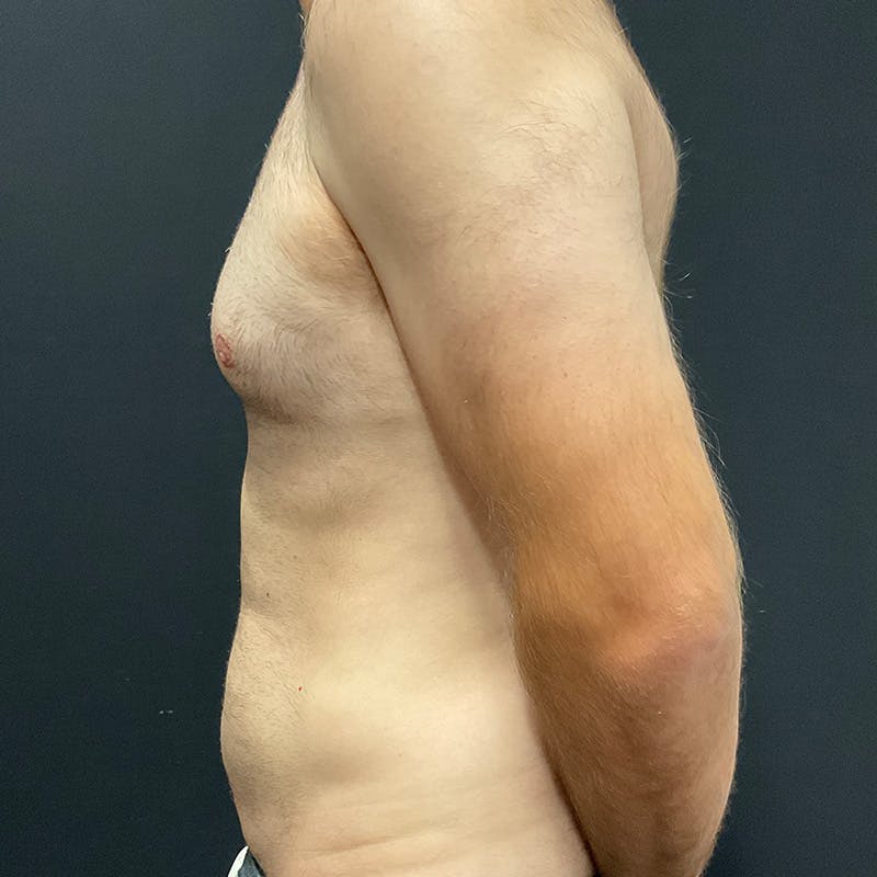 Male Liposuction Before & After Gallery - Patient 275331 - Image 9