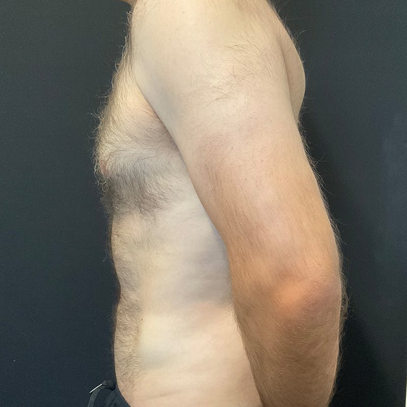 Male Liposuction Before & After Gallery - Patient 275331 - Image 10