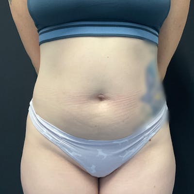 Liposuction Before & After Gallery - Patient 224098 - Image 1