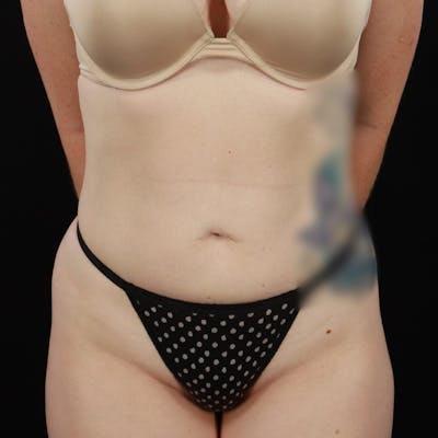 Liposuction Before & After Gallery - Patient 224098 - Image 2