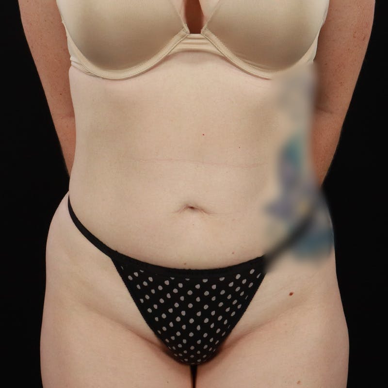 Bodytite By Inmode Before & After Gallery - Patient 388919 - Image 2