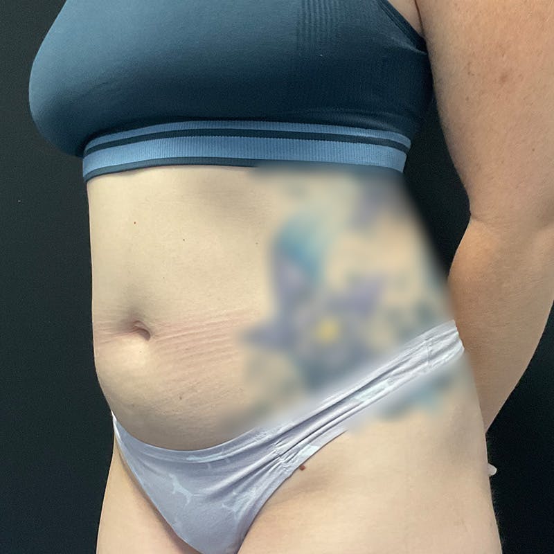 Liposuction Before & After Gallery - Patient 224098 - Image 7