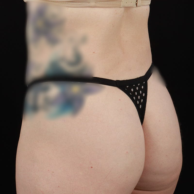 Liposuction Before & After Gallery - Patient 224098 - Image 12