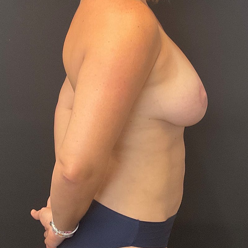 Breast Lift Before & After Gallery - Patient 581981 - Image 6
