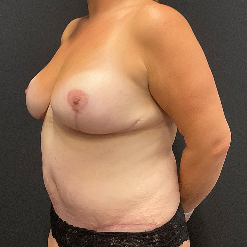 Breast Lift Before & After Gallery - Patient 179491 - Image 8
