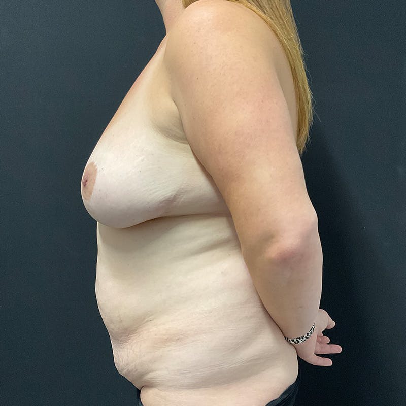 Breast Lift Before & After Gallery - Patient 179491 - Image 9