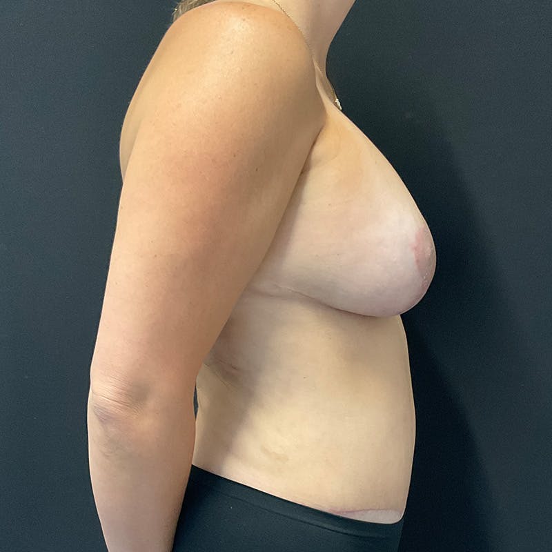 Breast Revision Before & After Gallery - Patient 423892 - Image 6