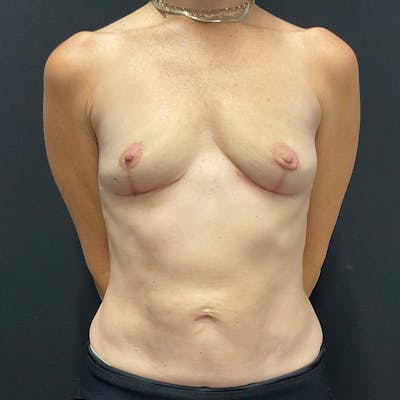Breast Explant with Lift Before & After Gallery - Patient 366176 - Image 2