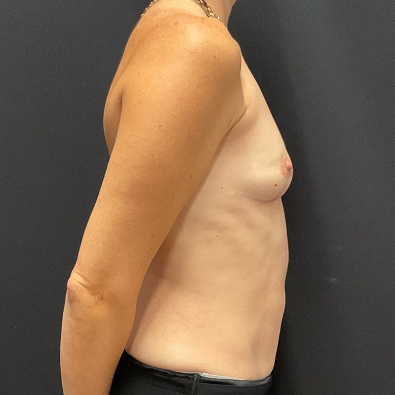 Breast Augmentation with Lift Before & After Gallery - Patient 198305 - Image 6