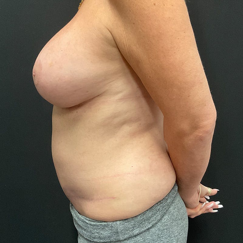 Breast Augmentation with Lift Before & After Gallery - Patient 198305 - Image 10