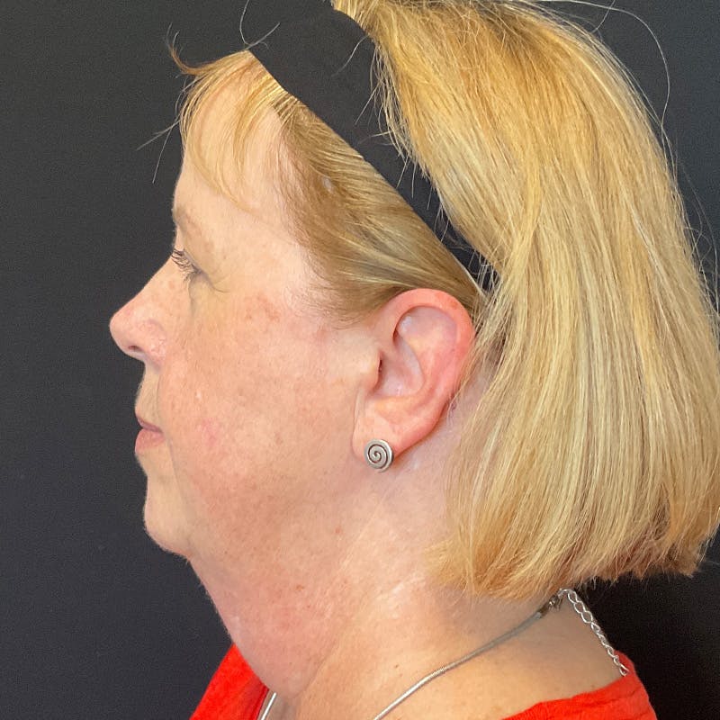 Neck Lift Before & After Gallery - Patient 419456 - Image 9