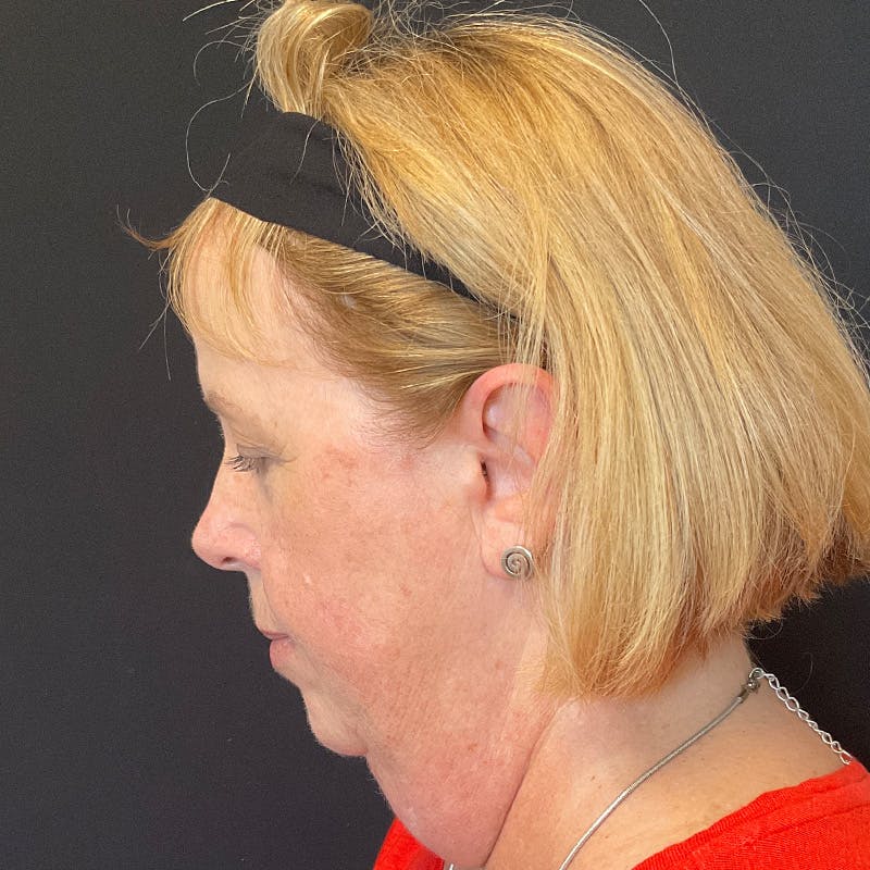 Neck Lift Before & After Gallery - Patient 419456 - Image 11