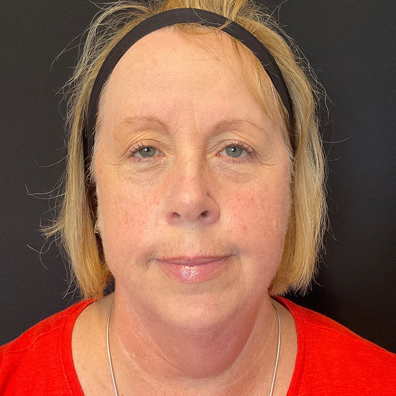 Neck Lift Before & After Gallery - Patient 419456 - Image 3