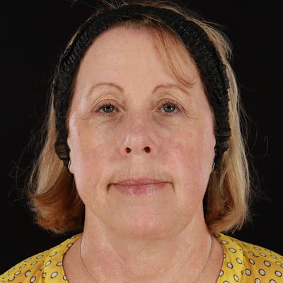 Neck Lift Before & After Gallery - Patient 419456 - Image 2