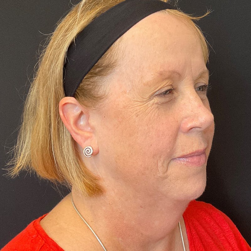 Neck Lift Before & After Gallery - Patient 419456 - Image 3