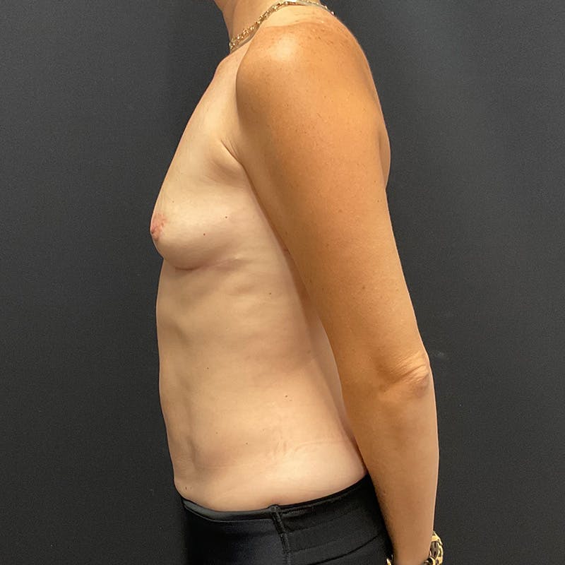 Breast Explant with Lift Before & After Gallery - Patient 366176 - Image 10