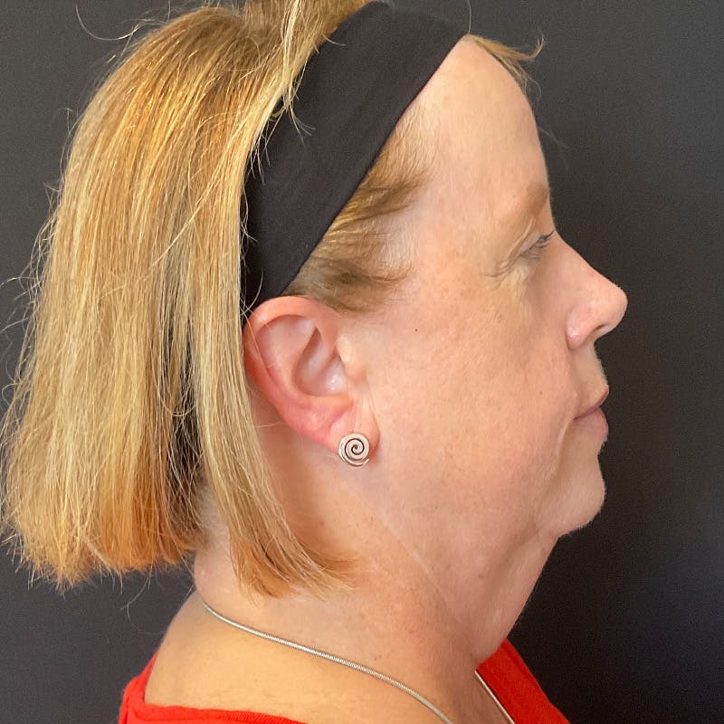 Neck Lift Before & After Gallery - Patient 419456 - Image 7
