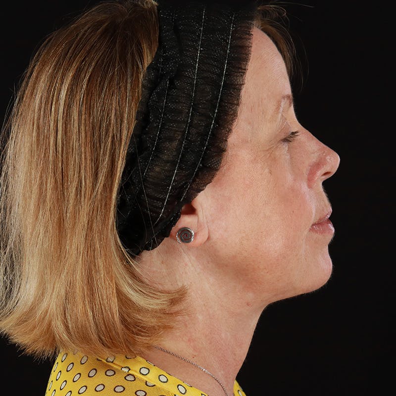 Neck Lift Before & After Gallery - Patient 419456 - Image 8