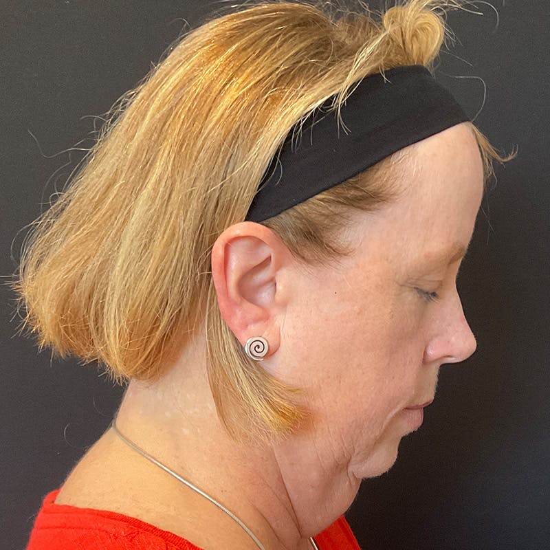 Neck Lift Before & After Gallery - Patient 419456 - Image 7
